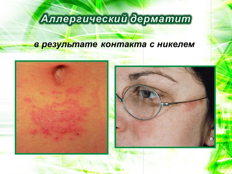 Аллергический дерматит в результате контакта с никелем